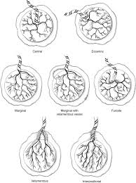Main outcome measures velamentous or marginal cord insertion. Https Refubium Fu Berlin De Bitstream Handle Fub188 24885 Doktorarbeit 20 20furcate 20cord 20insertion 20 20upload Pdf Sequence 1 Isallowed Y