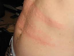 Image result for Urticaria pigmentosa children
