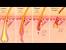 Deep Ingrown Hair Removal