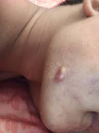 Check spelling or type a new query. Keloid Post Accutane What Should I Do To Get Rid Of It Accutane