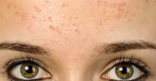 This is caused due to the onset of puberty and hormonal changes that. Forehead Acne And Pimples Causes Treatment And Prevention