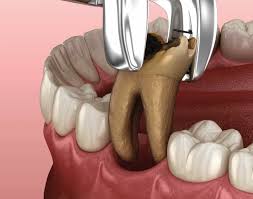 Image result for Tooth Extraction