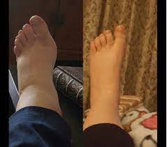 Pin On Plantar Facitis Pain Varicose Veins Remedies