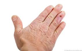 Image result for phlegmon of hand)