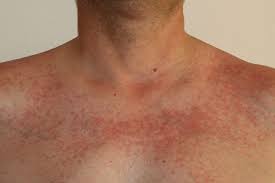 Image result for Photodermatitis