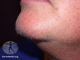 So, now are you wondering on how to remove hair from face? Treating Hirsutism In Women With Pcos