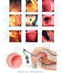 Image result for Anoscopy