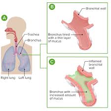 Image result for Acute Bronchitis