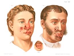 Image result for Tertiary Syphilis