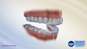 About one to two hours on average. How Long Does It Take To Put Braces On How Long To Get Braces On