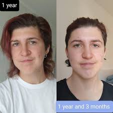 Transmasc they/he] Haven't posted here in a while, so I'm a slower guy when  it comes to changes, here's what happened to my face after the one year mark!  Still no sign