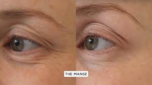 Maybe you would like to learn more about one of these? Under Eye Wrinkles Best Clinic Sydney For Dermal Fillers