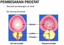 Dah lama mencari solusi untuk kurangkan masalah beliau, akhirnya beliau bertemu. Kencing Tak Lawas Bengkak Prostat Genkimomma My