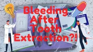 How many days after having. What To Do To Stop Bleeding After Tooth Extraction How To Control Bleeding After Extraction Youtube
