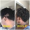 As with all hair loss treatments, some side effects may occur. 1