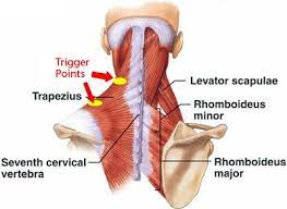 Myofascial Pain Syndrome