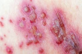 Image result for itchy skin rectum