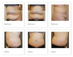 Tummy liposuction is the most popular liposuction across the world. Mr Oliver S Abdmonioplasty Before After Patient Results David Oliver Consultant Plastic Reconstructive And Aesthetic Surgeon Devon South West Of Uk
