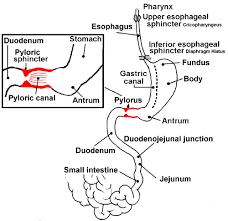 the legacy of john caffey shaken baby or pyloric stenosis