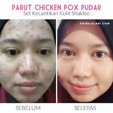 Dalam video ini ditunjukkan kepada anda kesan pengambilan vitamin c terhadap kulit muka dan kesihatan saya. Testimoni Esp Vitamin C Puan Akma Shima Jelani Pengedar Shaklee Shah Alam