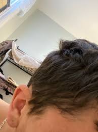 It can affect your pet's skin and its endocrine system, lymphatic system, and immune system. Hair Loss And Thinning On Side Of My Head Is This Temporary Never Experienced This Until Accutane No One In My Family Has Ever Had Hair Loss Either Accutane