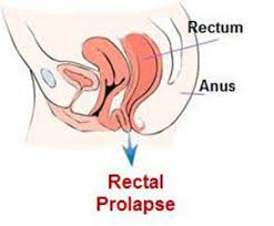 Image result for Rectal prolapse