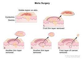 Cancerous lumps are hard like stone. Soft Tissue Sarcoma Hematology Oncology Associates Of Cny