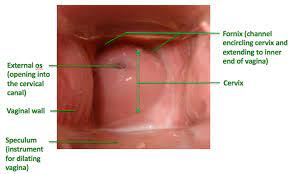 Dr barnouti, specialist plastic surgeon in vagina surgery, and labiaplasty, vagina inner lips, in sydney australia. Something Is Hard Inside My Vagina What Could That Be Quora