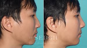 Nose surgery before and after male. Male Rhinoplasty Sedgh Plastic Surgery