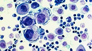 Symptoms and diagnosis symptoms of breast cancer that has spread to the learn how to lower the cost of metastatic breast cancer care, ways to create a support network. Metastatic Breast Cancer What You Should Know