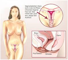 Scheidenpilz Vaginalpilz Ursachen Symptome Behandlung Medlexi De