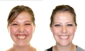 Braces Before & After Pictures