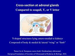 Doppler Ultrasound Of The Kidneys In 2020 Ultrasound Kidney Vein Thrombosis