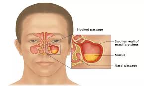 As always, contact your doctor before starting any new. Mepolizumab May Reduce Size Of Nasal Polyps Need For Surgery In Chronic Rhinosinusitis