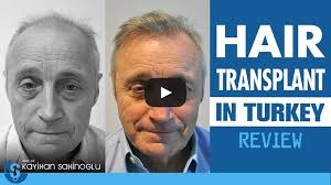 Travelling for a hair transplant in turkey is even more alluring as you'll get both the location and unparalleled quality treatment. Hair Transplant Turkey Dr Kayihan Sahinoglu Clinic Istanbul