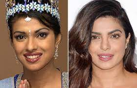 Top 25 Celebrities Before And After Plastic Surgery And Nose Jobs