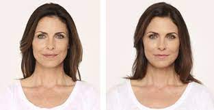 Dermal Fillers In Santa Barbara Facial Fillers Juvederm Injections Facial Fillers Dermal Fillers Nose Fillers