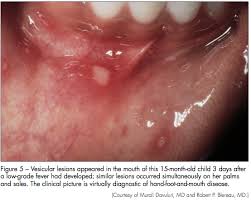 Image result for Mouth ulcers symptoms roof of the mouth