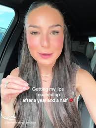 My Lip Filler Experience After 1.5 Years: Touch-Up Insights and Cosmetic  Tips