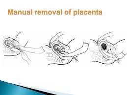 5/11/ manual placenta removal involves the removal of a retained placenta after childbirth. Ppt Postpartum Hemorrhage Powerpoint Presentation Free Download Id 1412420