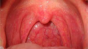 Rash And Swollen Lymph Nodes Causes Photos And Treatment
