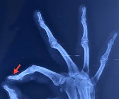 Image result for Glomus tumor