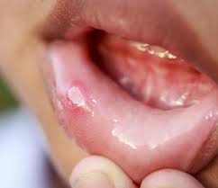Duelen, molestan, y están en un lugar bastante húmedo como para curarse rápidamente. Las Aftas Bucales Empeoran Con El Tabaco Dentalnova Salud Bucodental Y Estetica Clinica Dental Verin