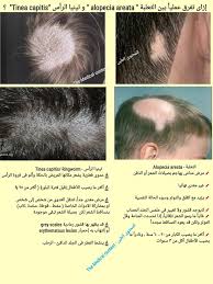 إزاى تفرق عمليا بين مرض الثعلبة The Medical Content المحتوى الطبى Facebook