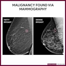 Mammography Mammogram Mammography Mammogram Diagnostic Imaging