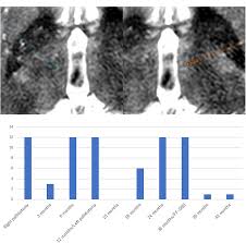 Image result for Pallidotomy