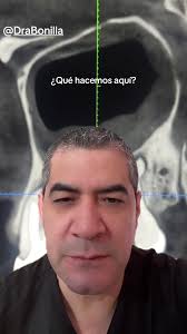 Las lesiones del seno maxilar por infecciones dentales son comunes y  generalmente son por los molares, este caso es muy interesante por la  comunicación directa que se observa en la imagen. Tuvo un ...