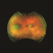 Image result for nevus sclerae