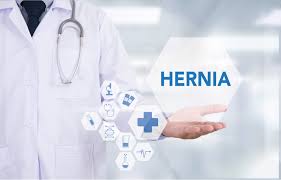 Being born with a larger hiatal opening than usual. Hernia Repair In Houston Tx Houston Robotic Hernia Surgery Dr Garza