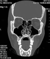 Doctors use a computed tomography (ct) scan, also called a cat scan, to find cancer. Septumdeviation Wikipedia